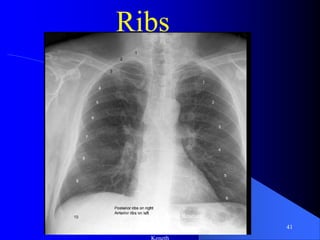 Chest x ray cxr and pathologies radiology training resource nchanji ...