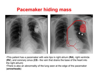Pacemaker hiding mass
•This patient has a pacemaker with wire tips in right atrium (RA), right ventricle
(RV), and coronary sinus (CS - the vein that drains the base of the heart into
the right atrium)
•There is also an abnormality of the lung seen at the edge of the pacemaker
(arrowheads)
 