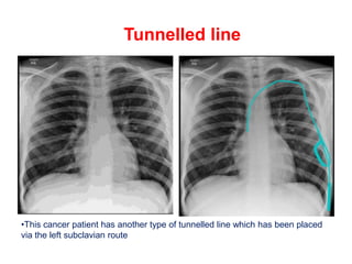Tunnelled line
•This cancer patient has another type of tunnelled line which has been placed
via the left subclavian route
 