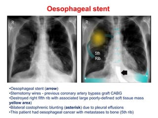 Oesophageal stent
•Oesophageal stent (arrow)
•Sternotomy wires - previous coronary artery bypass graft CABG
•Destroyed right fifth rib with associated large poorly-defined soft tissue mass
yellow area)
•Bilateral costophrenic blunting (asterisk) due to pleural effusions
•This patient had oesophageal cancer with metastases to bone (5th rib)
 