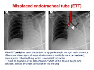 CHEST X-RAY DEVICES AND ARTIFACTS pptx.pptx