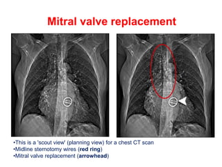 Mitral valve replacement
•This is a 'scout view' (planning view) for a chest CT scan
•Midline sternotomy wires (red ring)
•Mitral valve replacement (arrowhead)
 