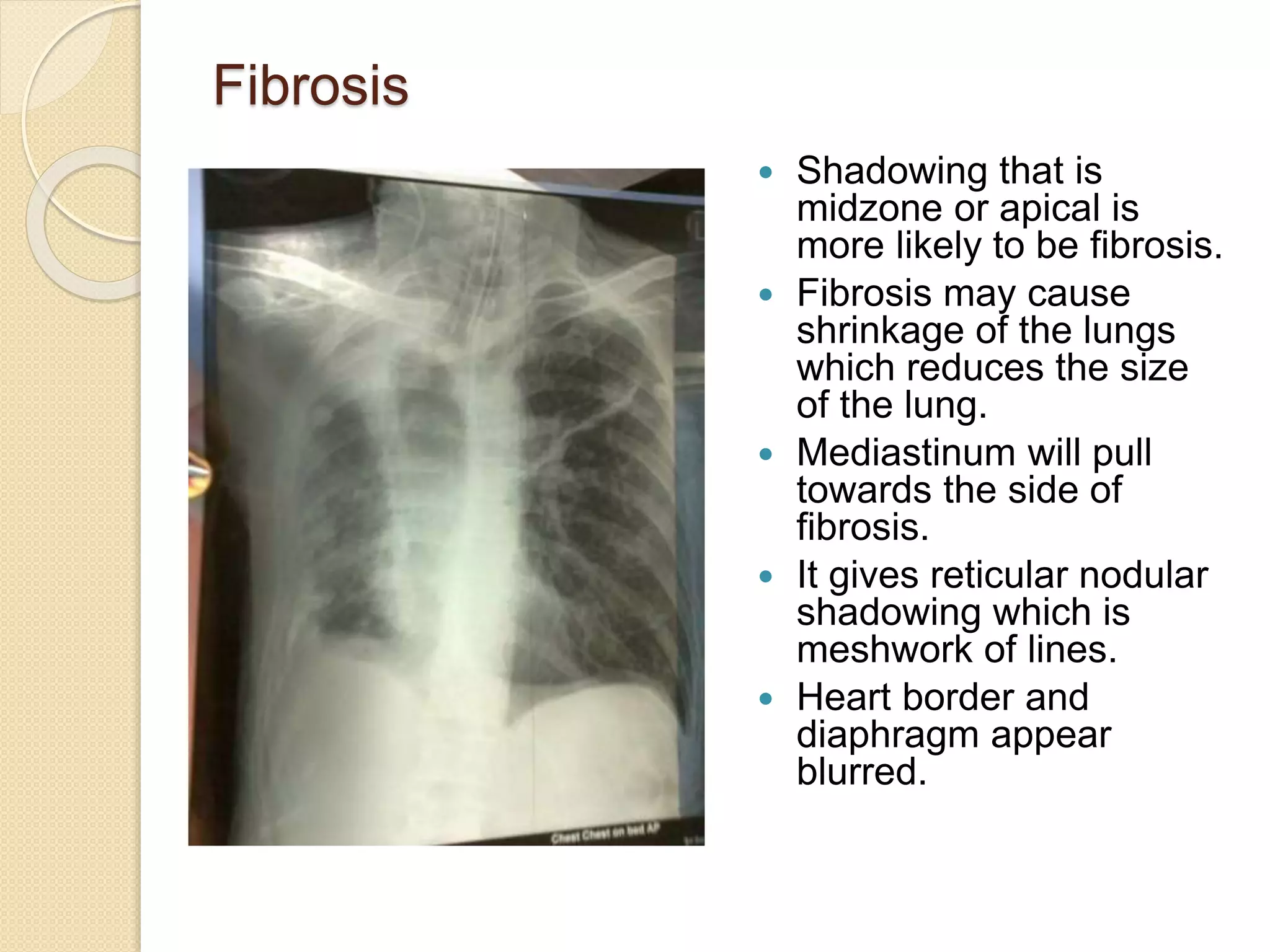 CHEST X-RAY F.pptx