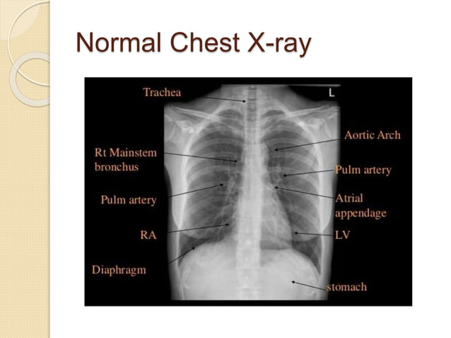CHEST X-RAY F.pptx | Lung and Respiratory Health | Diseases and Conditions