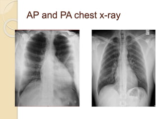 CHEST X-RAY F.pptx