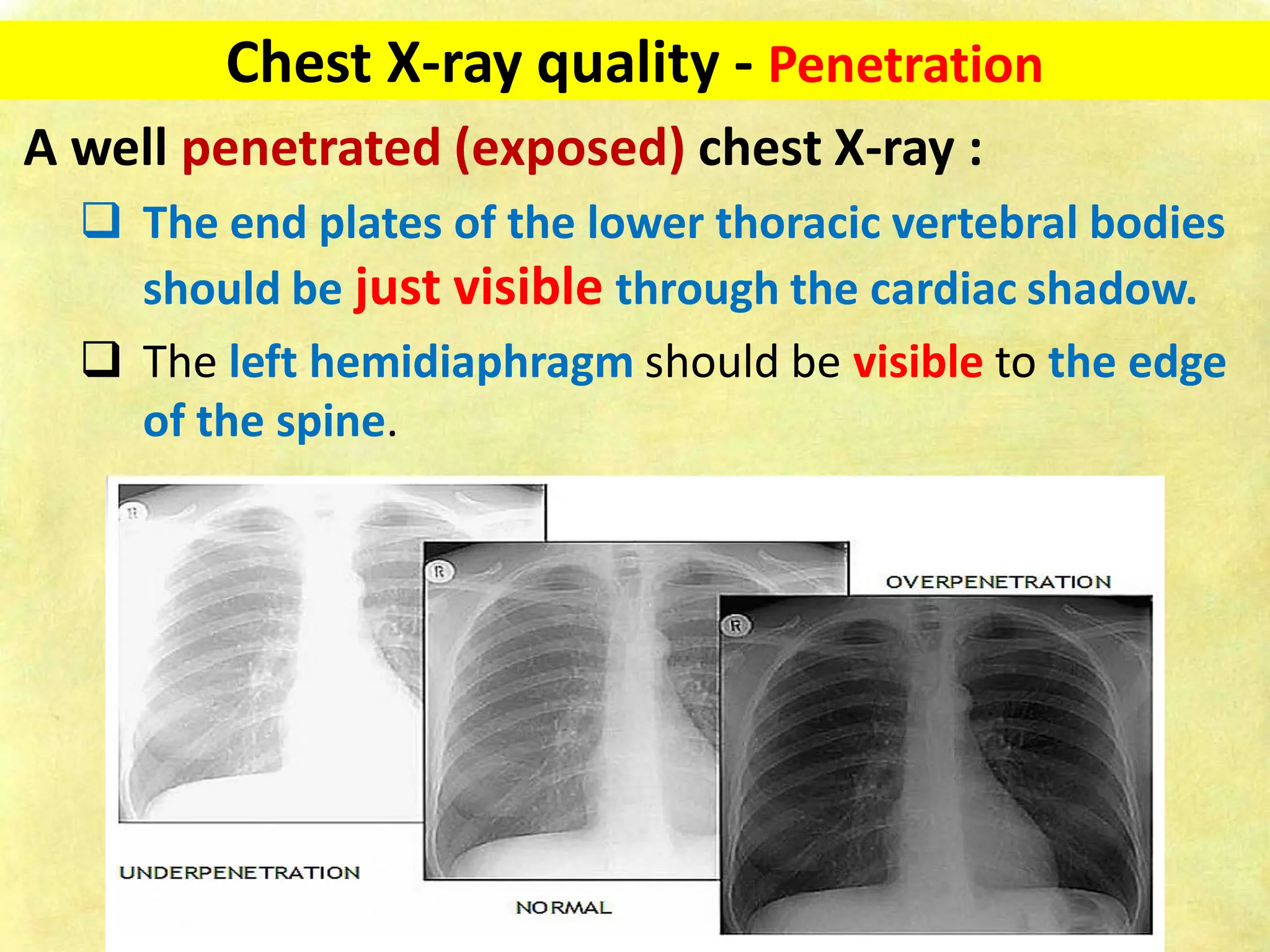 Chest X-ray Fundamentals on Acquisition and Interpretation.pdf