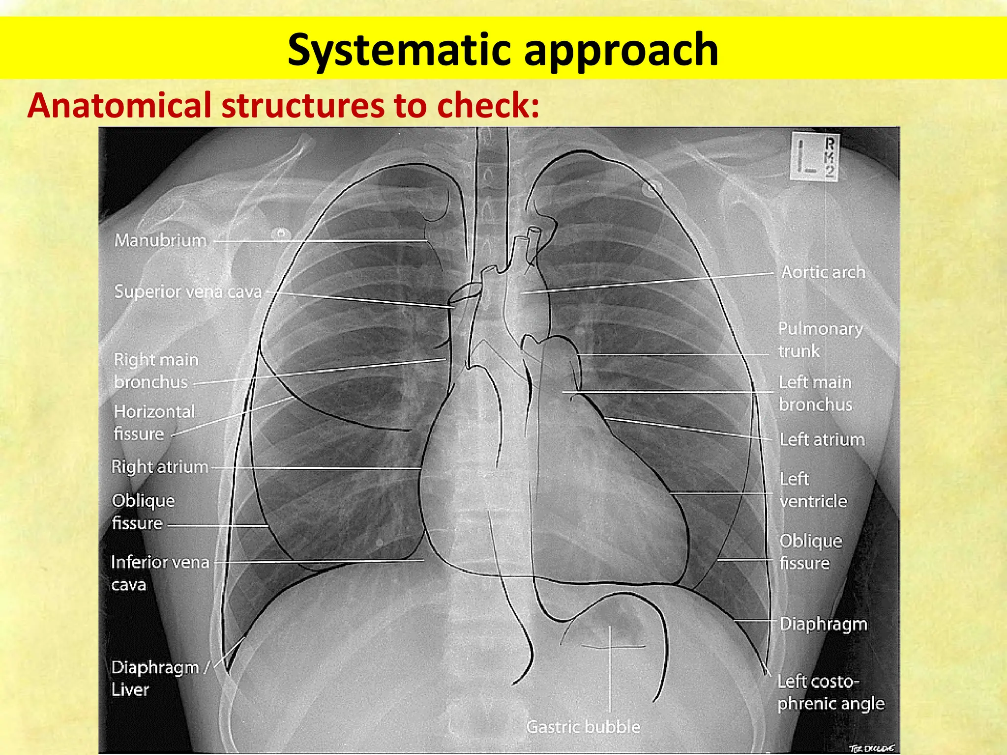Chest X-ray Fundamentals on Acquisition and Interpretation.pdf