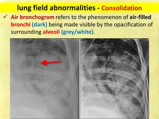 Chest X-ray Fundamentals on Acquisition and Interpretation.pdf