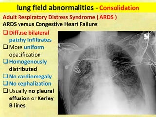 Chest X-ray Fundamentals on Acquisition and Interpretation.pdf