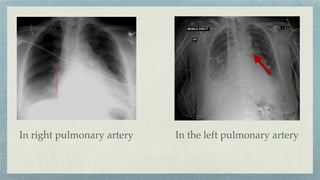In the left pulmonary artery
In right pulmonary artery
 