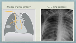 Wedge shaped opacity C/L lung collapse
 