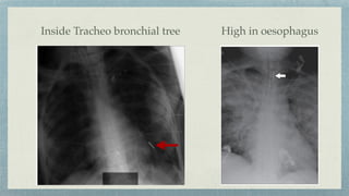 High in oesophagus
Inside Tracheo bronchial tree
 