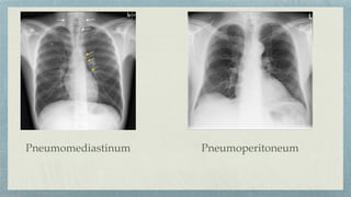 Pneumomediastinum Pneumoperitoneum
 
