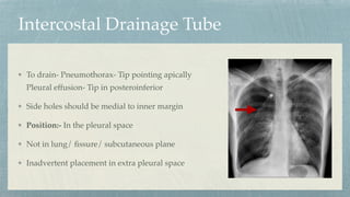 Intercostal Drainage Tube
To drain- Pneumothorax- Tip pointing apically
Pleural effusion- Tip in posteroinferior
Side holes should be medial to inner margin
Position:- In the pleural space
Not in lung/
fi
ssure/ subcutaneous plane
Inadvertent placement in extra pleural space
 