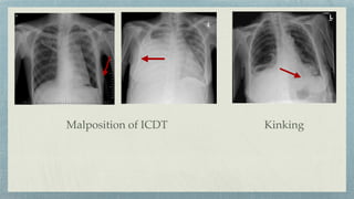 Malposition of ICDT Kinking
 