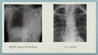 Right main bronchus At carina
 