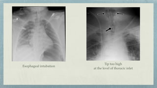 Esophageal intubation
Tip too high
at the level of thoracic inlet
 