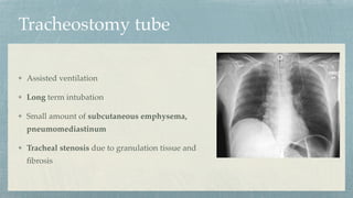 Tracheostomy tube
Assisted ventilation
Long term intubation
Small amount of subcutaneous emphysema,
pneumomediastinum
Tracheal stenosis due to granulation tissue and
fi
brosis
 
