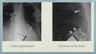 Fracture of the lead
Correct placement
 
