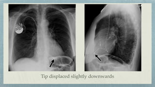Tip displaced slightly downwards
 