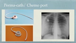 Perma-cath/ Chemo port
 
