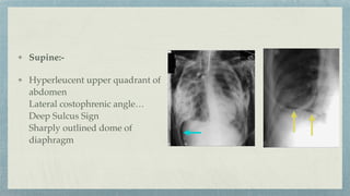 Supine:-
Hyperleucent upper quadrant of
abdomen
Lateral costophrenic angle…
Deep Sulcus Sign
Sharply outlined dome of
diaphragm
 