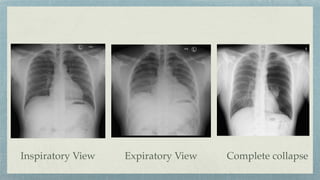 Inspiratory View Complete collapse
Expiratory View
 