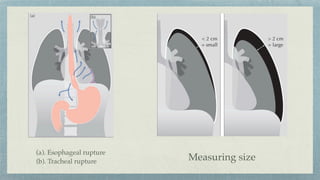 (a). Esophageal rupture
(b). Tracheal rupture Measuring size
 