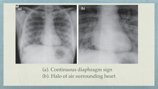 (a). Continuous diaphragm sign
(b). Halo of air surrounding heart
 