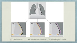 (c). Pneumopericardium
(a). Pneumothorax (b). Pneumomediastinum
 
