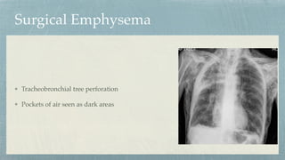 Surgical Emphysema
Tracheobronchial tree perforation
Pockets of air seen as dark areas
 