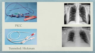 PICC
Tunneled: Hickman
 