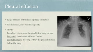 Pleural effusion
Large amount of
fl
uid is displaced in supine
No meniscus, only veil like opacity
Types:-
Lamellar- Linear opacity, paralleling lung surface
Encysted- Loculation within a
fi
ssure
Subpulmomary- Pooling within the pleural surface
below the lung
 
