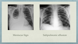 Meniscus Sign Subpulmonic effusion
 