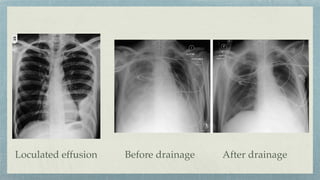Loculated effusion Before drainage After drainage
 