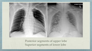 Posterior segments of upper lobe
Superior segments of lower lobe
 