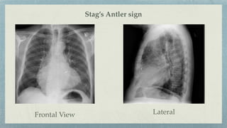 Frontal View Lateral
Stag’s Antler sign
 