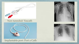 Non tunneled: Vascath
Implantable port: Port a Cath
 