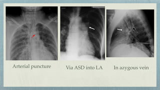 Arterial puncture Via ASD into LA In azygous vein
 