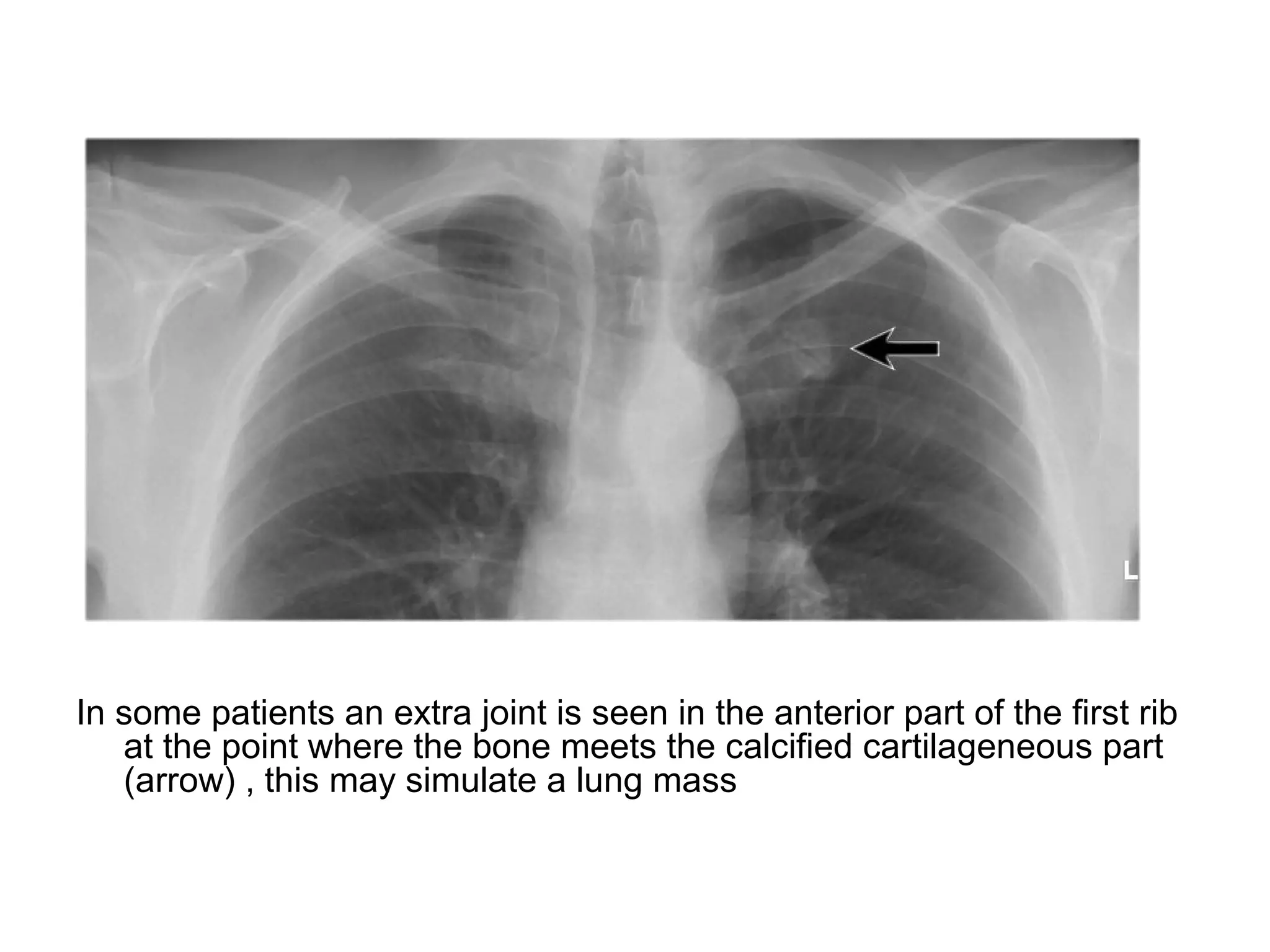 Chest X-rays Basic Interpretation | PPT