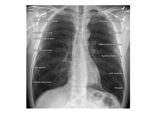 Sternum Rx Chest X-rays Basic Interpretation | PPT