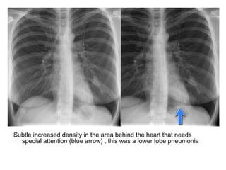 Subtle Pna Chest X-rays Basic Interpretation | PPT