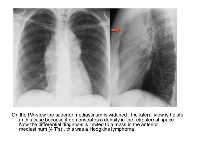pneumonia xrays lobe