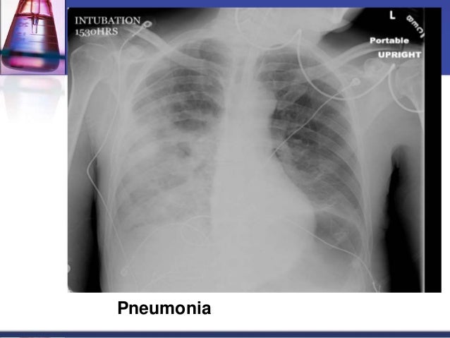 Copd X Ray Interpretation Kronis F