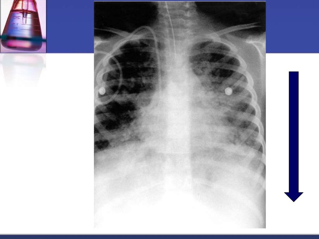 Chest x ray interpretation