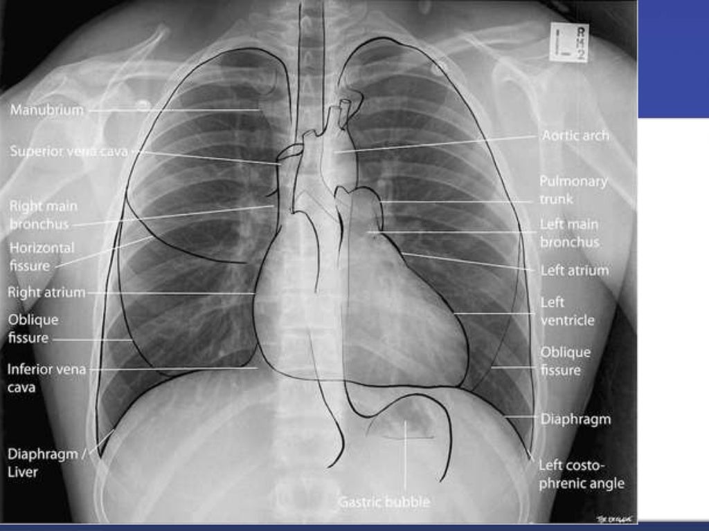Chest x ray interpretation