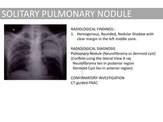 Easy guide to Chest x-ray Interpretation & Case Studies | PPTX