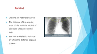 Rotated
 Clavicle are not equidistance
 The distance of the anterior
ends of ribs from the midline of
spine are unequal on either
side.
 The film is rotated to that side
on which the distance appears
greater.
 