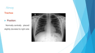 Airway
Trachea
 Position:
Normally centrally placed/
slightly deviated to right side
 