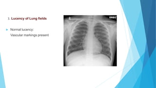 3. Lucency of Lung fields
 Normal lucency:
Vascular markings present
 
